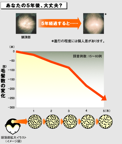 男性型脱毛症（AGA）  最上クリニック－予約優先診療・日帰り手術で 