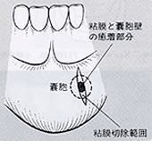 図２：口唇嚢胞摘出術