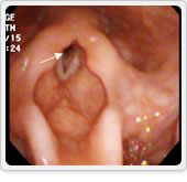写真４：声帯下の粘膜が腫脹しています（矢印）