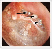 写真８：後天性真珠腫 矢印（→）：真珠腫による鼓膜穿孔と骨欠損が見られます。