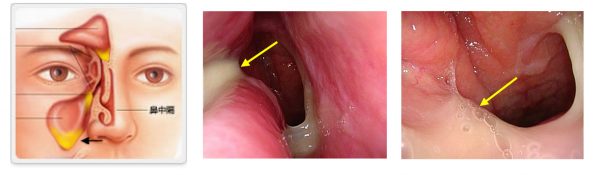 図・写真１：右急性副鼻腔炎：右上顎洞に膿（黒矢印）が溜まり、右鼻腔内に膿の分泌（黄矢印）を認めます。