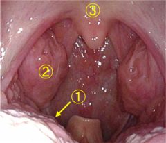 写真１：正常な口腔、咽頭の構造