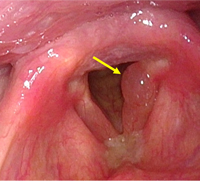 写真５：左声帯が全体的に腫れている（矢印）