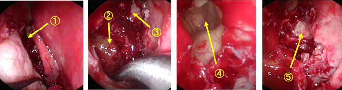 写真３：手術の実際：右の①中鼻道、②上顎洞、③篩骨洞、④前頭洞、⑤蝶形洞を順次開放している。