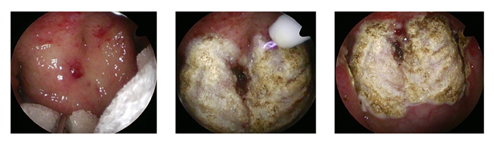 写真３：上咽頭粘膜焼灼術の手術所見