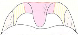 図３：手術のシェーマ：破線部分（ピンク色）を切除し縫合する。