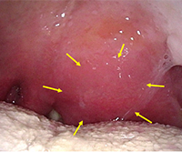 写真３：膿瘍ができ軟口蓋が著しく腫脹している （矢印）。
