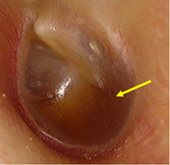 写真・図２：早期滲出性中耳炎の鼓膜 矢印：鼓室に浸出液が溜まっている。