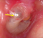 写真４：急性中耳炎の鼓膜。 矢印：鼓室に膿が溜まり、鼓膜が 膨隆しています。