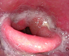 写真３：重症例：喉頭浮腫を伴います